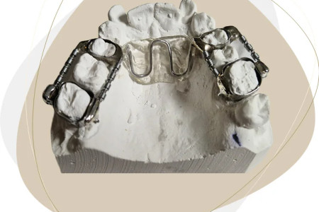 Aparat GMD – Greenfield Molar Distalizer